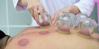 cupping fat loss